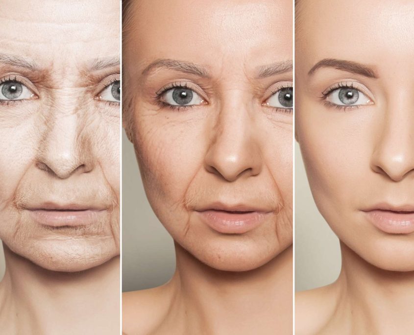 anti-aging procedures on caucasian woman face anti-aging procedures on caucasian woman face