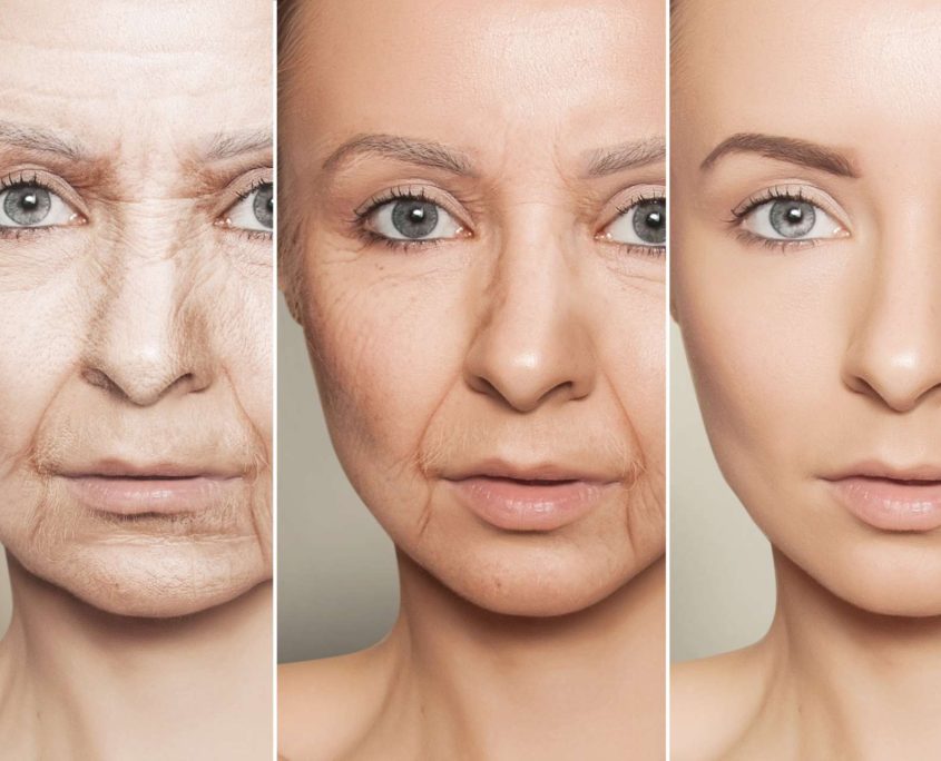 anti-aging procedures on caucasian woman face