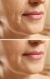 Mature woman face before and after cosmetic procedure. Plastic surgery concept. Mature woman face before and after cosmetic procedure. Plastic surgery concept.