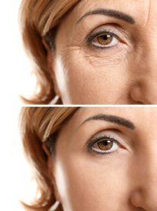 Mature woman face before and after cosmetic procedure. Plastic surgery concept. Mature woman face before and after cosmetic procedure. Plastic surgery concept.