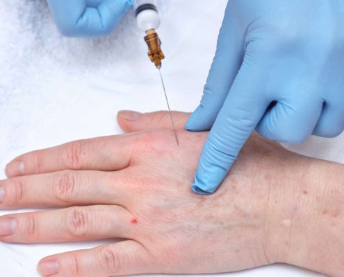 Anti-age injection therapy. Hand rejuvenation.