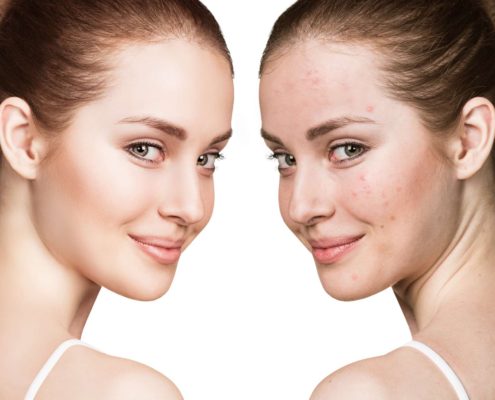 Girl with acne before and after treatment Girl with acne before and after treatment
